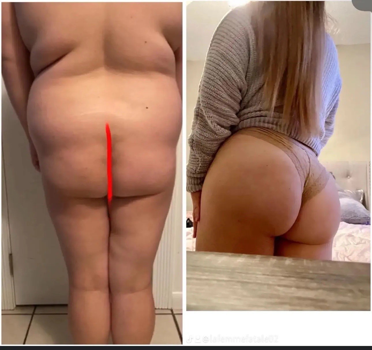 Rapid-Action BBL Syrup Butt Enlargement for Quick Growth – Lifting and Firming